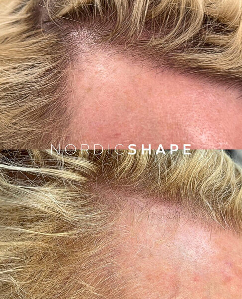 <b>nordicshape-hiuspohjan-boosteri-1</b>